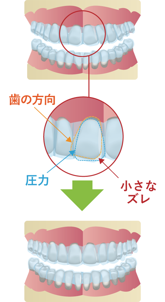 マウスピース矯正の仕組み