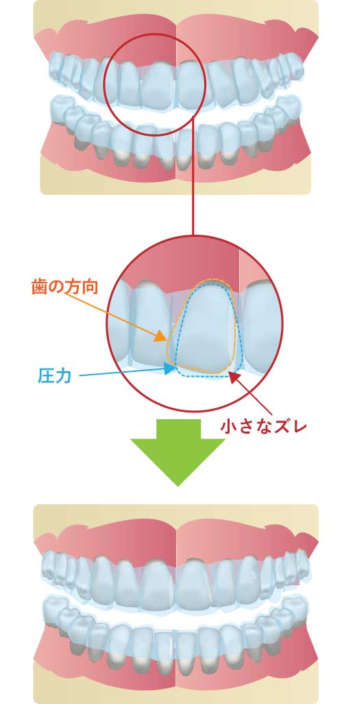 マウスピース矯正の仕組み