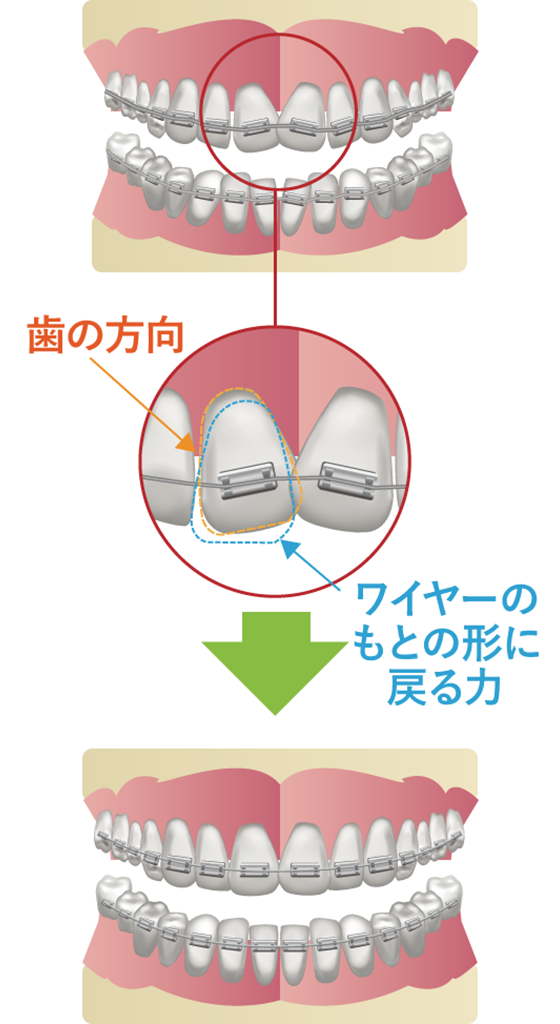ワイヤー矯正の仕組み