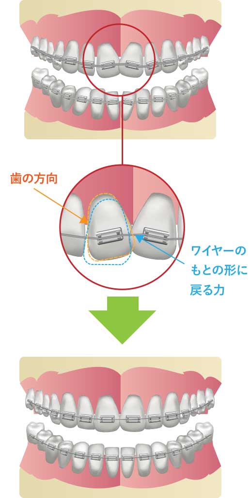 ワイヤー矯正の仕組み