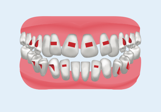3Dの歯のシミュレーション